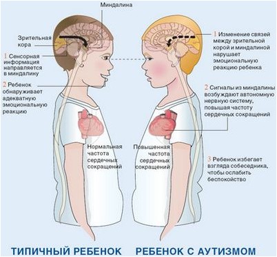 синдром синдром