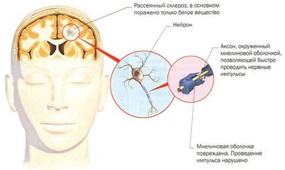 склероз склероз