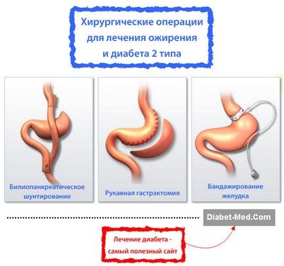 пересадка