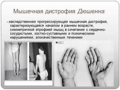 Новая мишень может замедлить прогрессирование заболевания при мышечной дистрофии Дюшенна